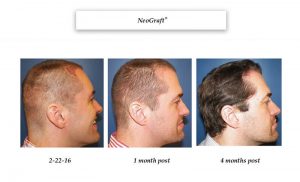 hair grafts Woodlands