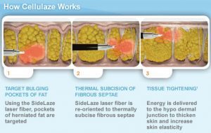 How cellulaze works on cellulite and orange peel skin or dimples