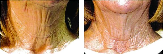 incissionless-mini-facelift-results-1