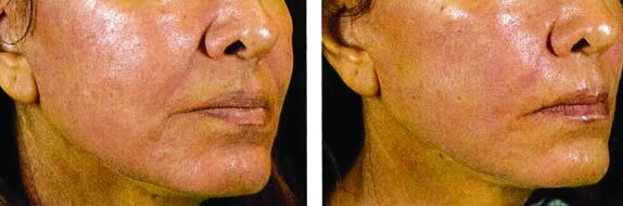 incissionless-mini-facelift-results-2 Mini facelift benefits