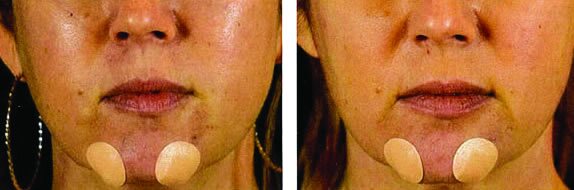 incissionless-mini-facelift-results-3