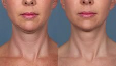 kybella-double-chin-img2