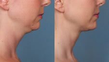 kybella-double-chin3 Double chin relief with Kybella