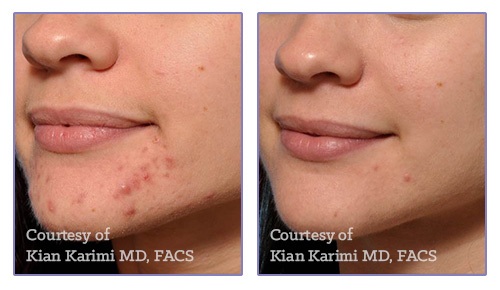 microneedlingcollagen-induction-therapy-cit-img2