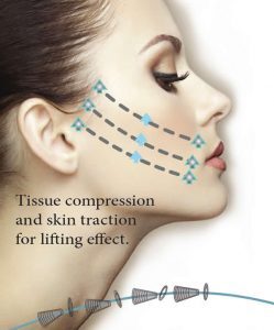 Silhouette Lift advantages