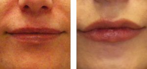 Juvederm application