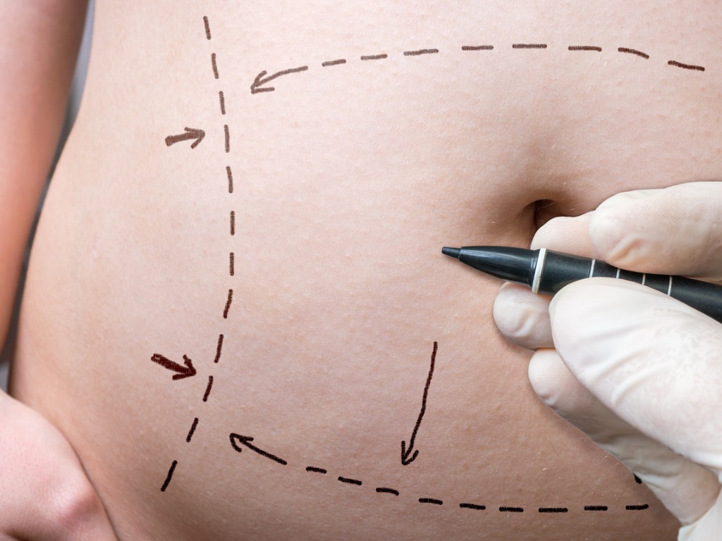 SmartLipo problem areas - Vedas Medical Spa & Wellness Center