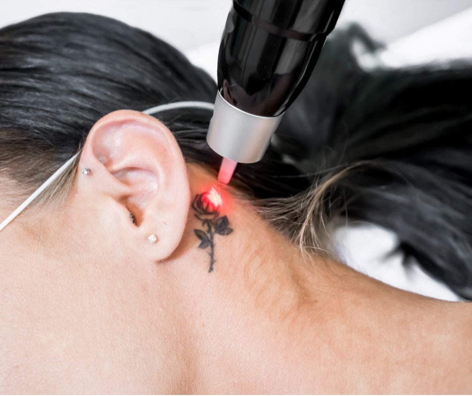 laser-tattoo-removal-treatment-session-on-patient-using-picosecond-picture-id1173734121 (1)