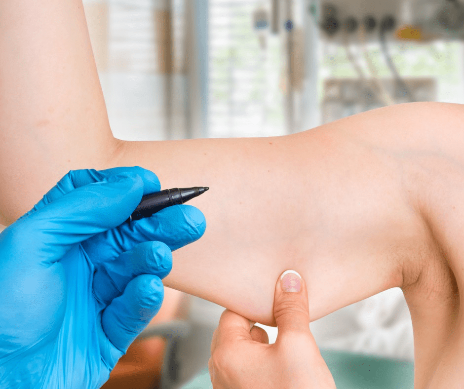 reshape with Smartlipo