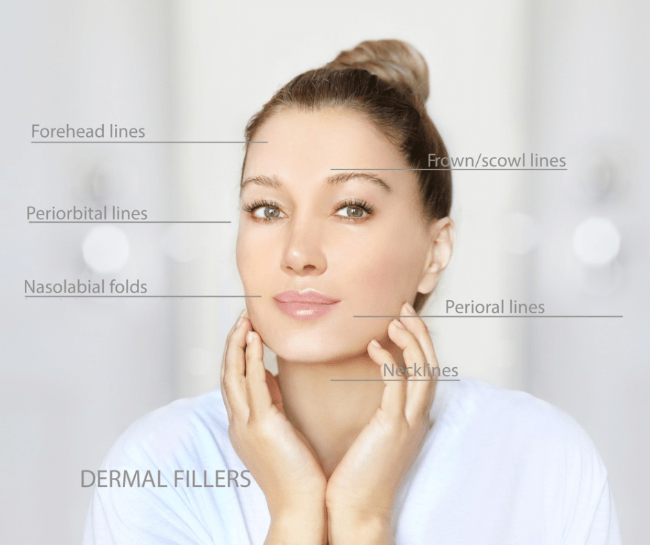 dermal filler