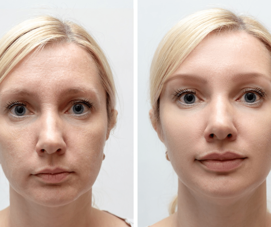 chemical peel