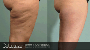 Cellulite FAQ explains Cellulaze treatment