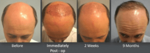 Hair Transplant preparation