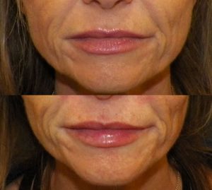 Injectable Restylane Silk for your perfect smile