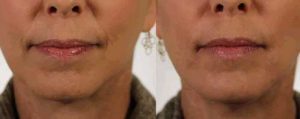 Injectable Revanesse Versa