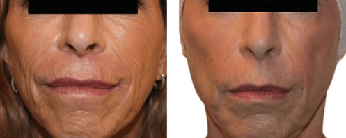 Vedas-Venus-Freeze Venus Freeze skin tightening