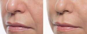 Injectable Bellafill dermal filler for nasolabial folds