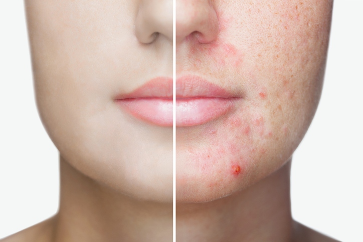 treating acne scars