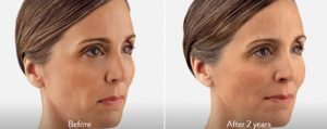Juvederm benefits