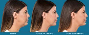 Injectable Kybella for your double chin