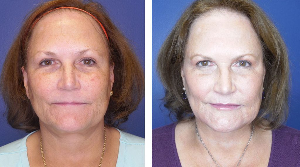 High-definition Y LIFT