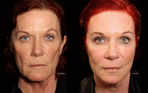 InstaLift Facelift