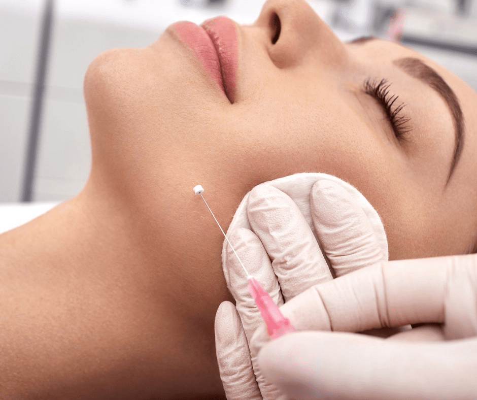 woman-receives-a-facelift-procedure-mesothreads-lifting-skin-cosmetic-picture-id1314796996