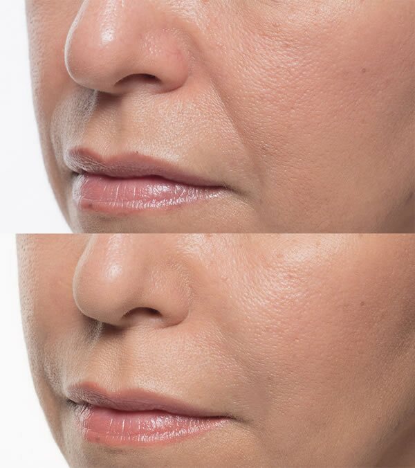 Injectable Bellafill for moderate to severe folds