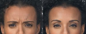 Injectable Botox wrinkle eraser