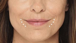Radiesse filler for smile lines: Botox and fillers are your friend!