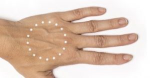 Radiesse hand thinning