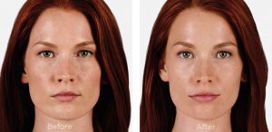 Voluma dermal filler