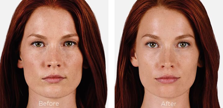 Voluma dermal filler