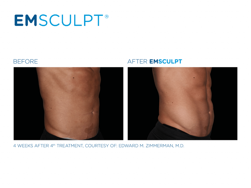 Emsculpt_PIC_FB-social-media-plan-190226_EN100