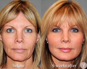women amazing results after the YLIFT procedure