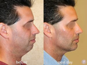 Y LIFT facial contouring