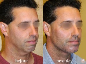 Y LIFT contouring