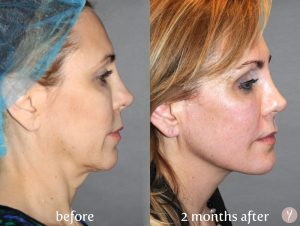 YLIFT facial rejuvenation