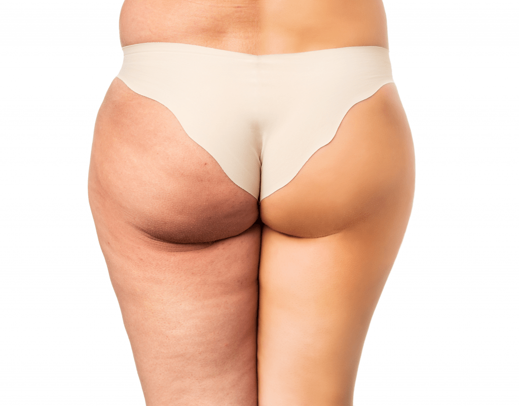 Treatment for cellulite that works: cellulite facts. Vedas Medical Spa & Wellness Center