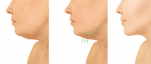 Defined jawline with Kybella