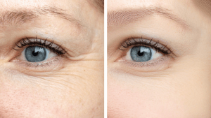 Botox injectables