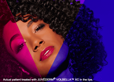 Juvederm filler special offer