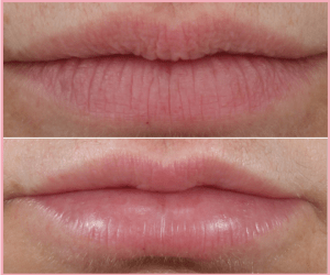 Lips fillers before and after