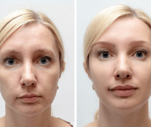 Juvederm special: beautiful lips!
