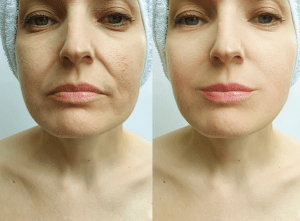 Smile line filler
