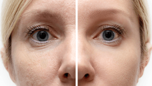 A before and after image of a woman having had a Chemical Peel