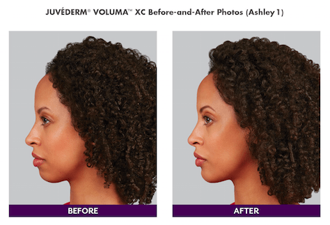 Juvederm Voluma