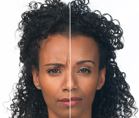 Image Allergan Before and After Botox Cosmetic