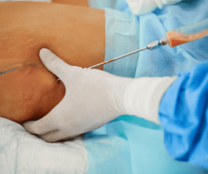 Shape changer: SmartLipo