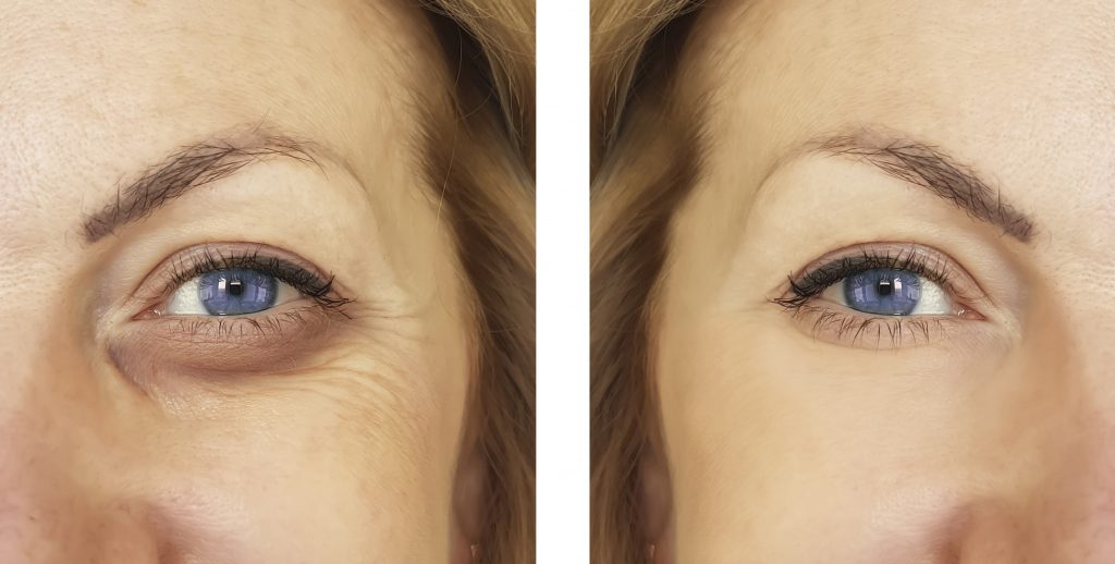 Tear troughs correction at Vedas Medical Spa & Wellness Center